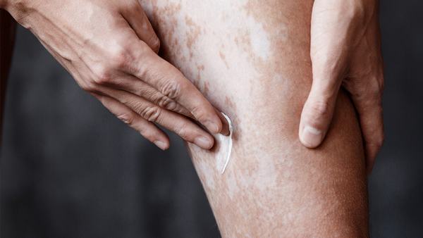 儿童白癜风为什么反复