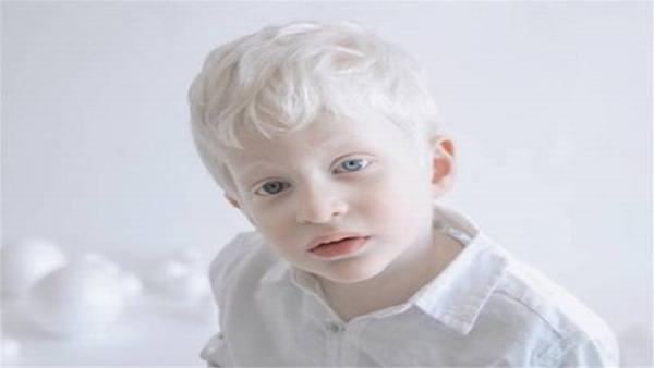 为什么会生出白化病的小孩