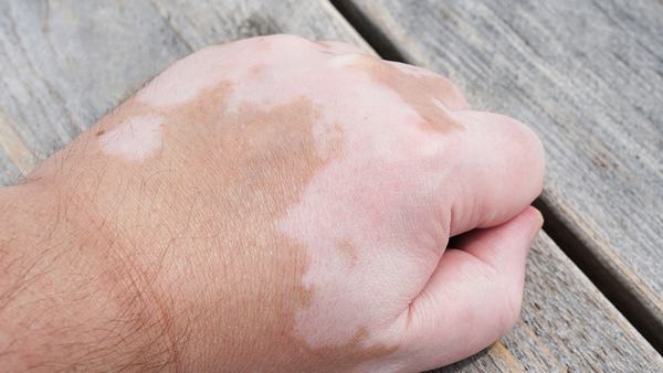 白癜风怎么传染