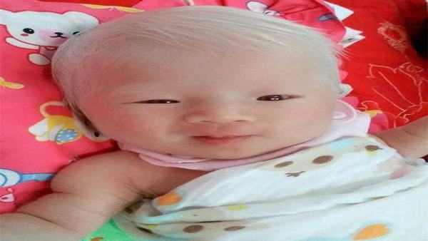 白化病会怎么样