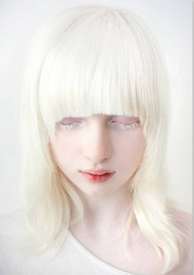 白化病为什么视力很低