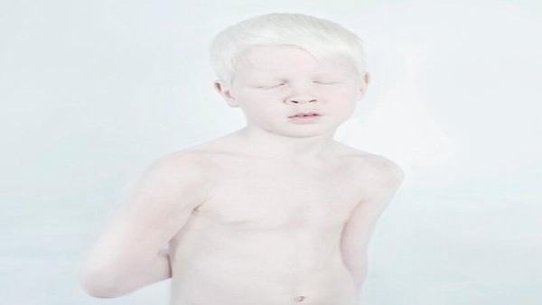 小儿白化病怎么发展