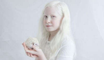 如何实现白化病遗传阻断