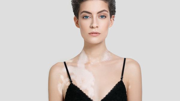 白癜风治疗时间是多久