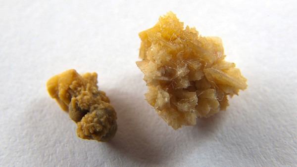 肝内胆管结石是什么原因引起的啊