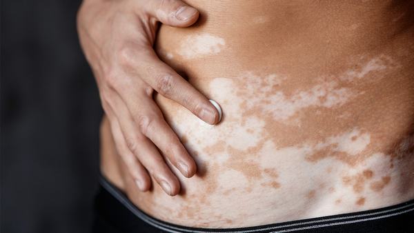 白癜风是怎么发的