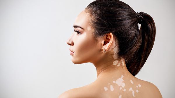 为什么白癜风治疗困难