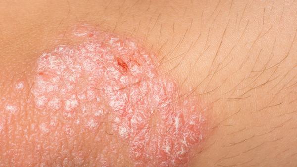 体癣传染吗通过什么传染