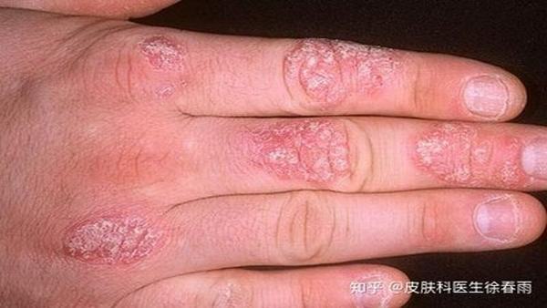 体癣和股癣的治疗方法