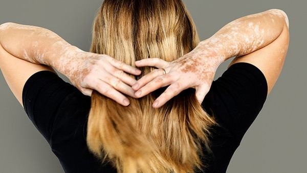 人为什么会得白癜风