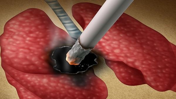 肺吸虫病的典型表现是什么样的