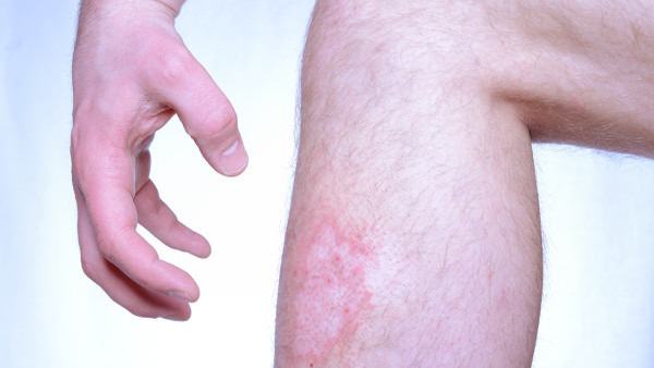 脖子体癣怎么治疗最有效