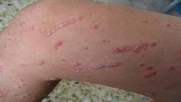 体癣多久可以好