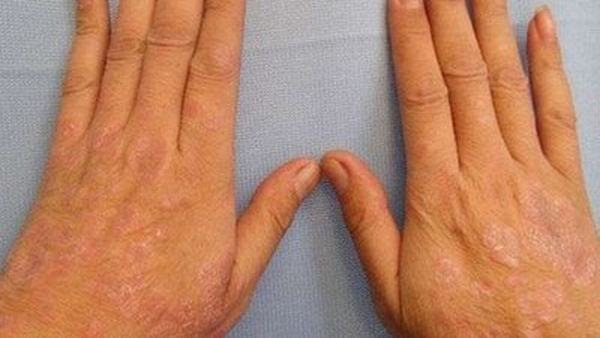 体癣可以自愈吗