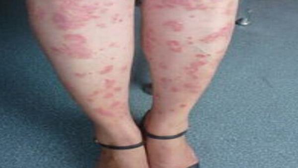 身上长体癣怎么办