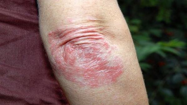 体癣和股癣可以喝牛奶吗