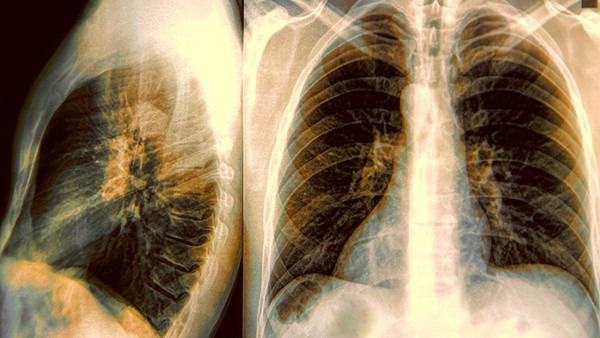 支气管结核传染途径