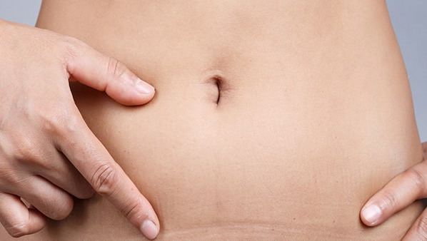 脐炎成人怎么治疗