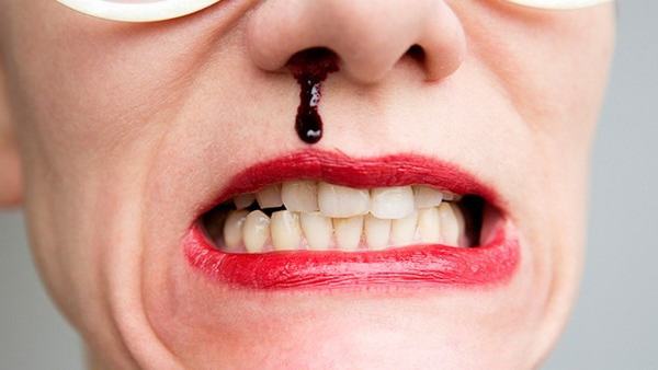 鼻出血护理诊断及护理措施有哪些