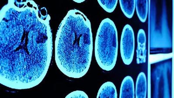 青年人得脑供血不足的危害