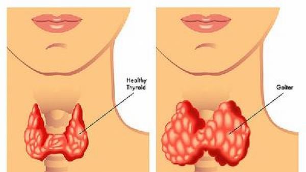 为何甲亢患者需要重复做甲状腺细针穿刺