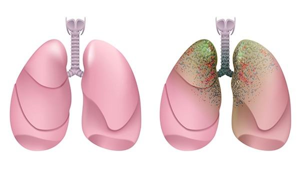 肺纤维化病人的护理方法有哪些