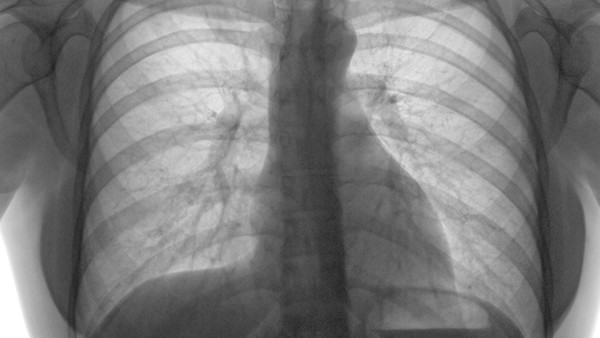 肺纤维化的饮食疗法