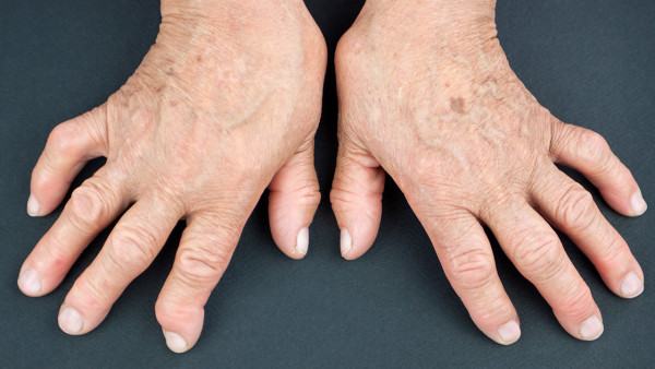 哪些人容易患痛风