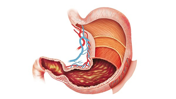慢性浅表性胃炎的最佳治疗方法是什么