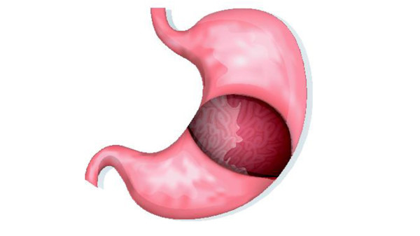 慢性浅表性胃炎为什么反复发作