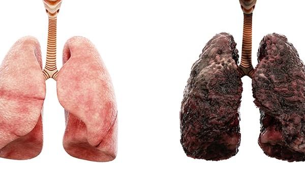 支气管扩张复发方法