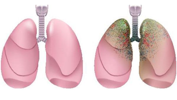 大叶性肺炎传染吗