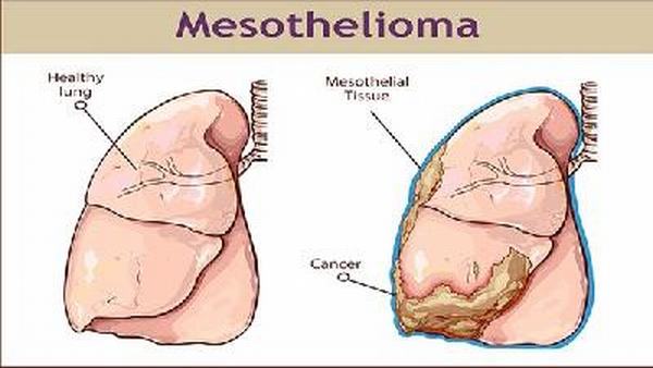 肺纤维化属于遗传病吗