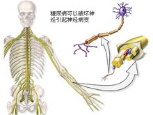 1型糖尿病性植物神经紊乱