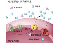 1型糖尿病