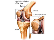 髌骨软骨软化