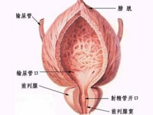 膀胱结石