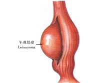 平滑肌瘤