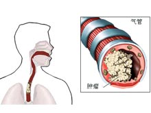 气管肿瘤