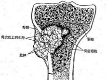 急性血源性骨髓炎