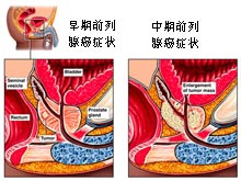 前列腺癌