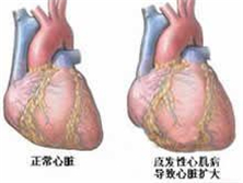 药物性心肌病