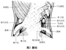 腰疝