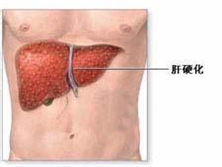 药物性肝硬化