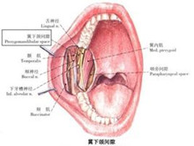 翼下颌间隙感染