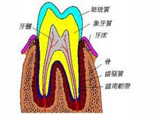 牙髓坏死