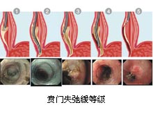 贲门失弛缓症