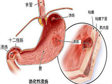 小儿消化性溃疡