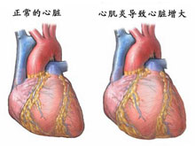 病毒性心肌炎