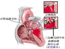 假腱索